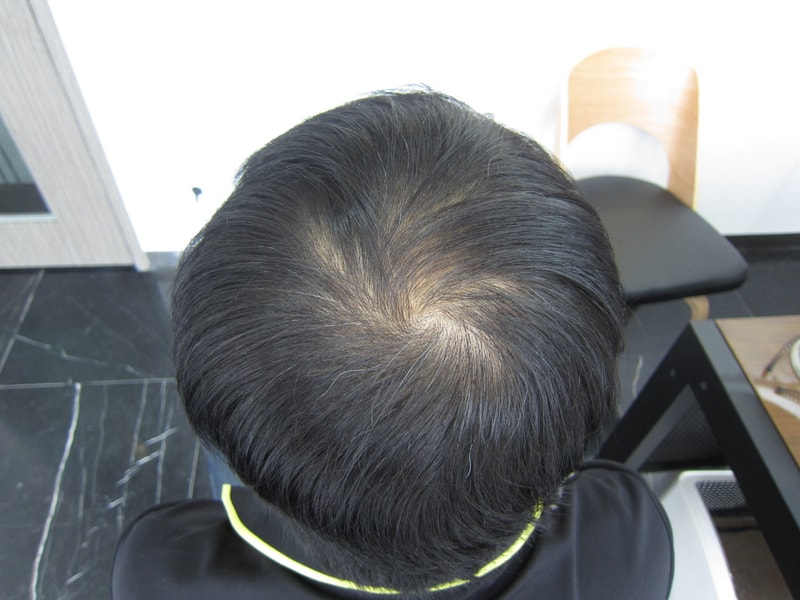 头皮纹身经过一个半月后上传^^