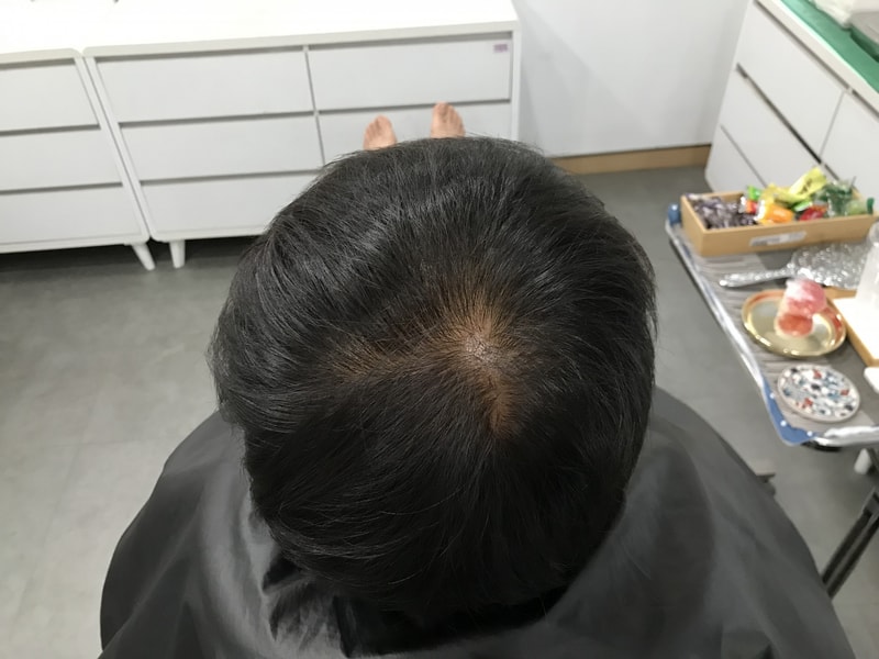 [頭皮タトゥー] ヨンセミダイン医院で1次頭皮タトゥーを入れた後、コメントをアップします~~~