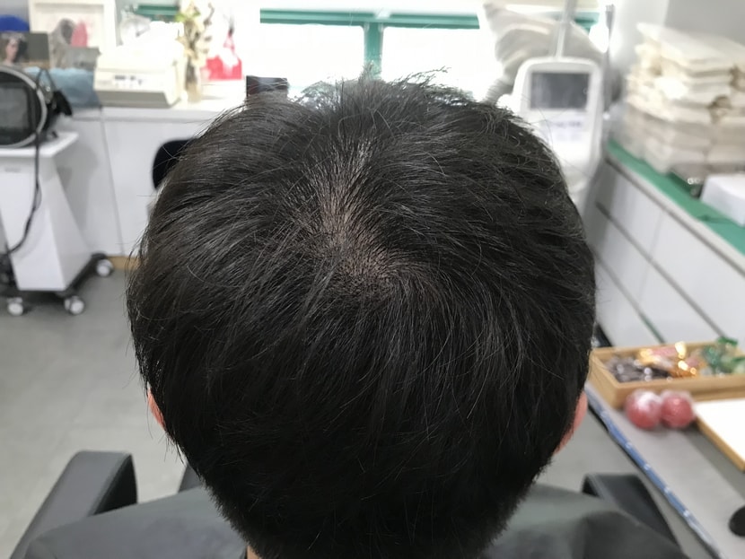 시술 직전 병원 샴푸 후 머리