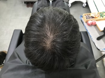 시술 직전 병원 샴푸 후 머리