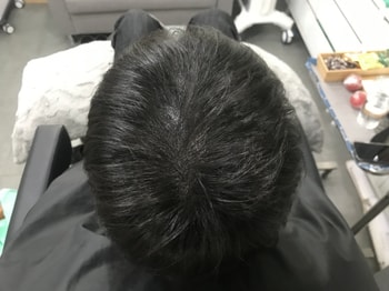 시술 직후 병원 드라이 머리