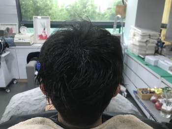시술 직후 병원 샴푸 머리