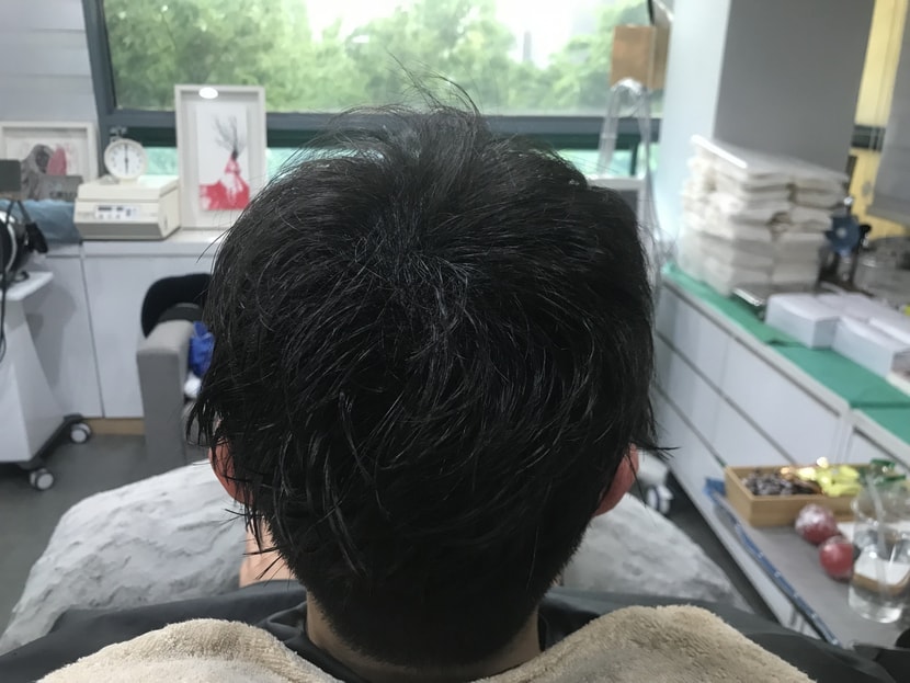 시술 직후 병원 샴푸 머리