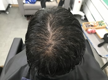 시술 직전 병원 샴푸 후 머리