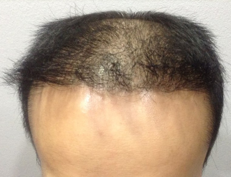 这是头皮纹身第二次后记。