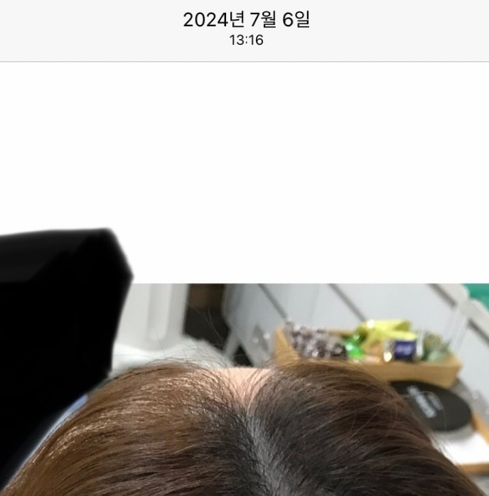 24년 7월 6일 두피 보톡스 맞음