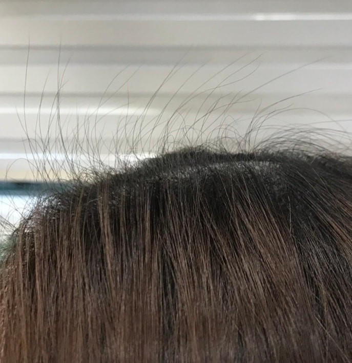 두피 보톡스 맞고 6개월 후
