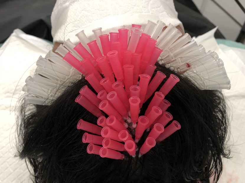 잔머리재생술