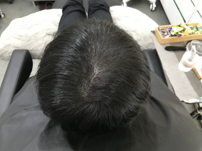 시술 후 마른 머리