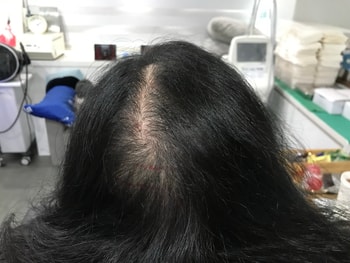 시술전