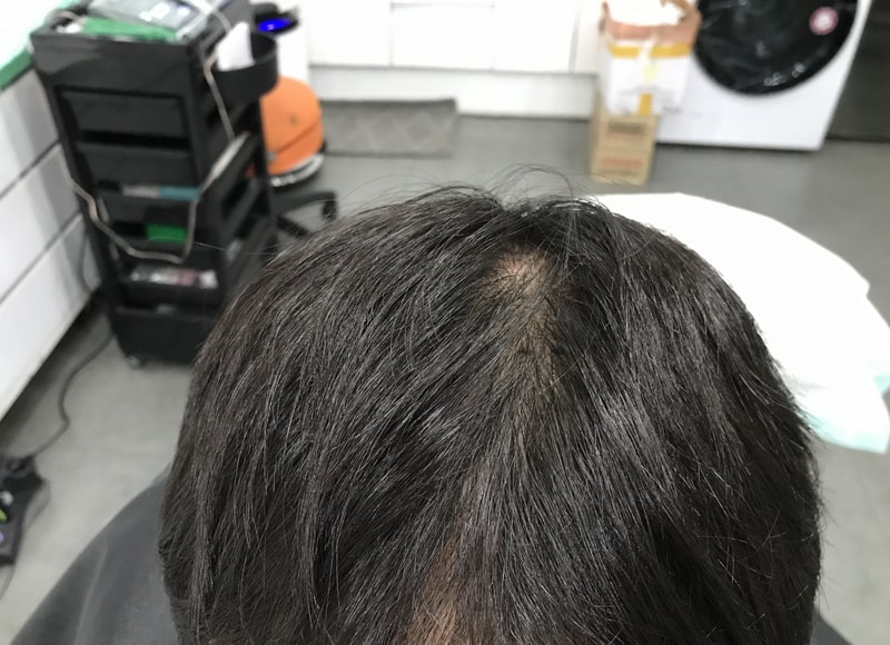延世美因树脂针 微细圆点 1次后期