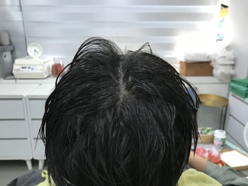 &lt;시술 후 젖은 머리&gt;