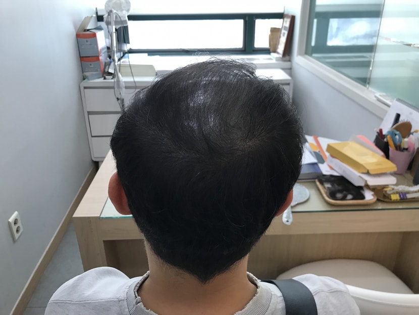 시술 2년차2