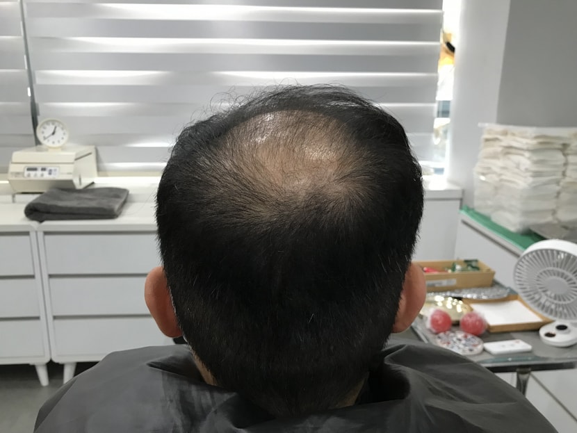 시술전3