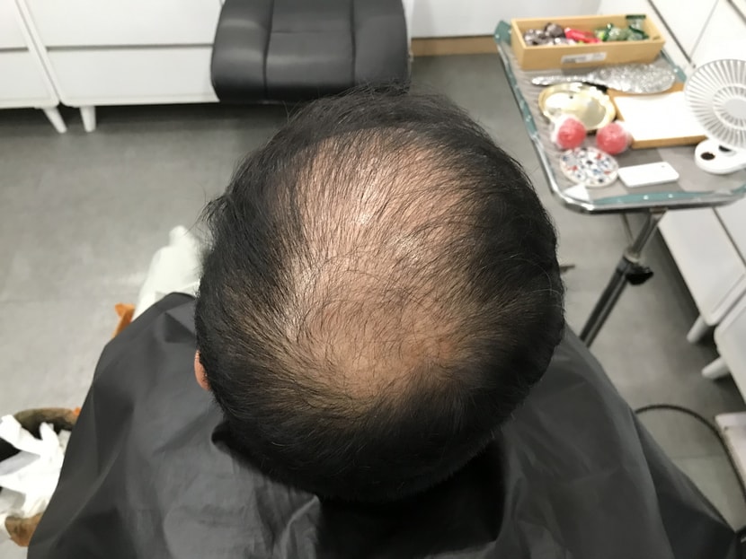 시술전1