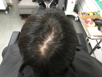 시술 전