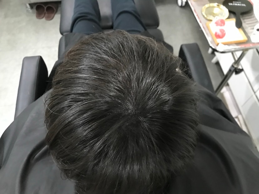 시술 후