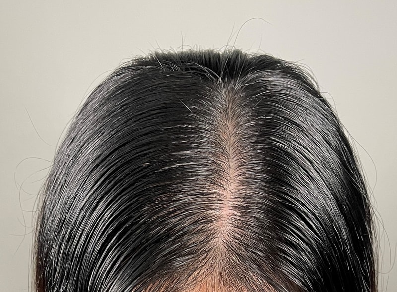 悩んだ末に頭皮を刺しました！！