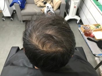 시술전