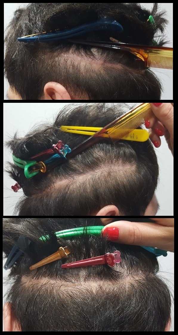 미켈란에서 절개식흉터 색소요법 받고 왔습니다.