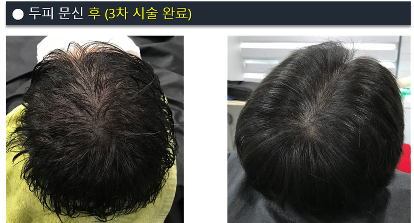 두피문신 완료 후 (3차 시술)