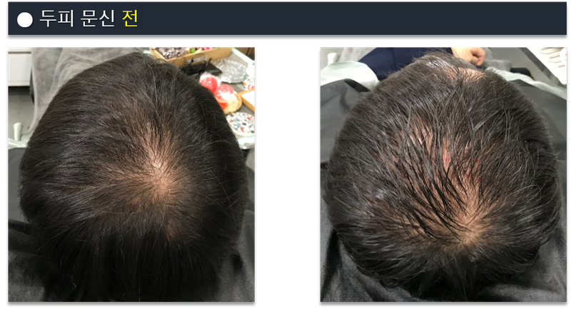 [基本ドット施術] 頭皮タトゥーリビュー