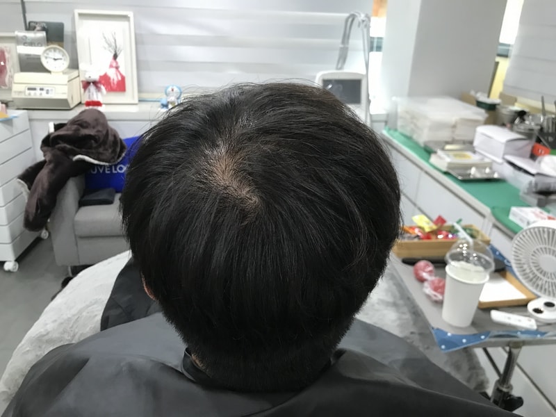 头皮纹身后期