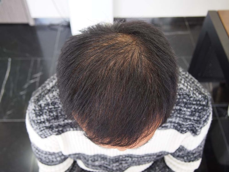 这是纹头皮一个月后的评论。