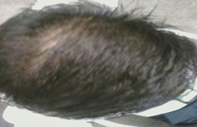 어제 뉴헤어에서 SMP시술받고왔습니다