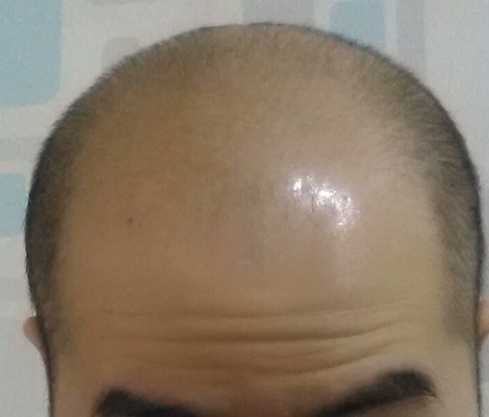 是光头皮纹身后记