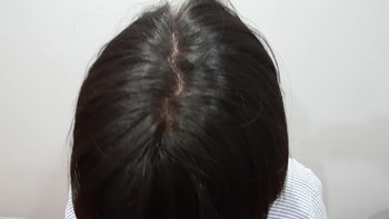 정수리 1차 직후