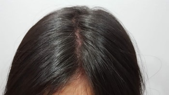 정수리 1차 직후