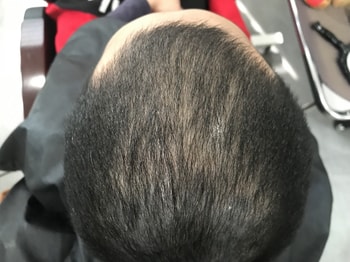 3주후 리터칭 받으로갔는데 앞쪽도 너무 텅텅비어서 추가