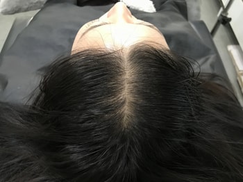 시술 전 젖은머리