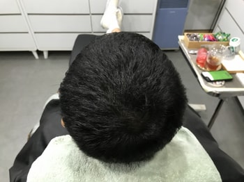 2차 리터치 시술 후