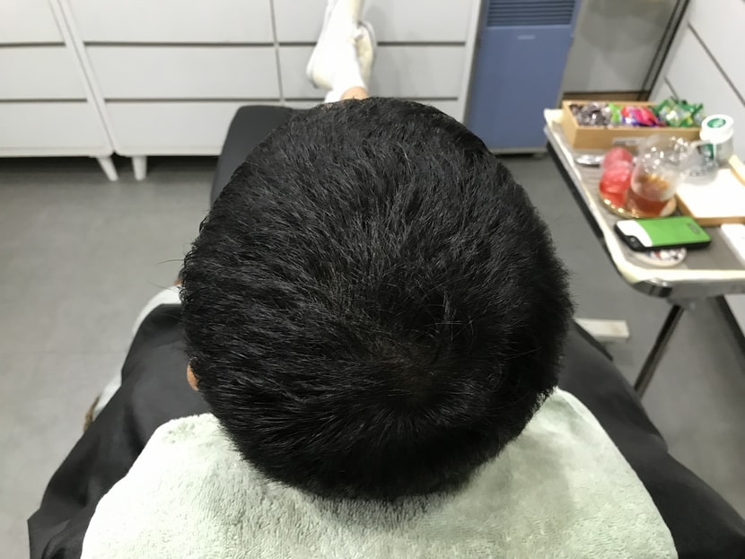 2차 리터치 시술 후