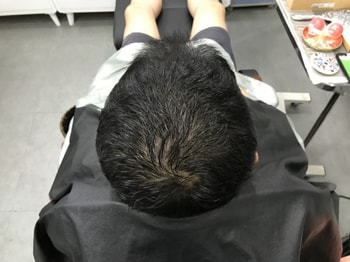 2차 리터치 시술 전