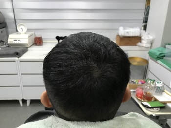 2차 리터치 시술 후
