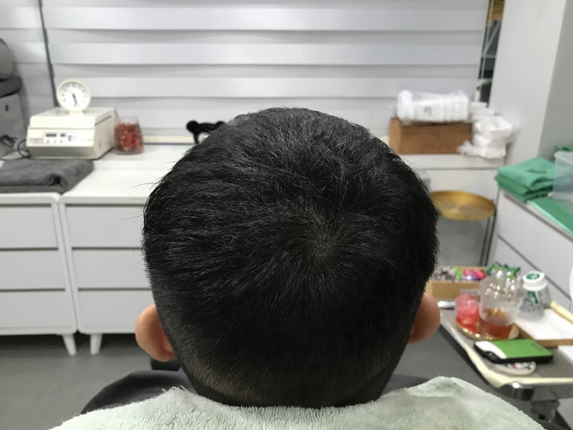 2차 리터치 시술 후