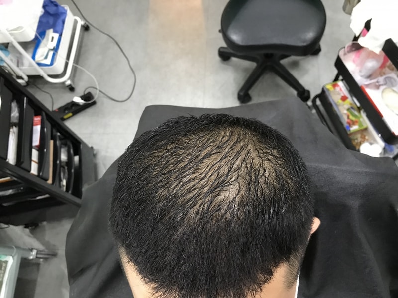 スジチム微細ドット1次体験談です~