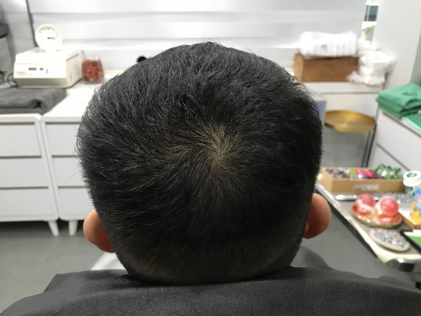 2차 리터치 시술 전
