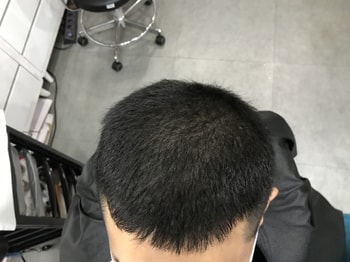 시술 후4