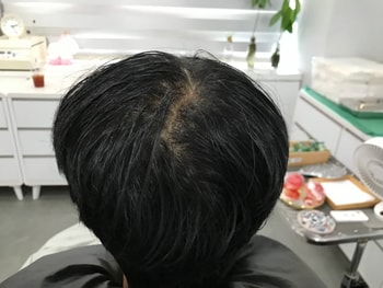 시술 전