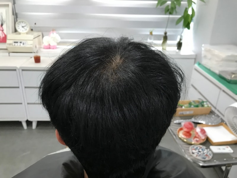 グラデーション ドット 技法 頭皮タトゥー 1次体験談