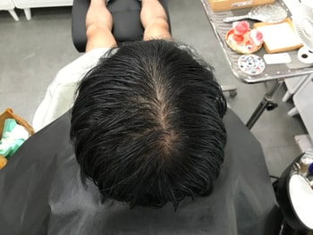 시술 전