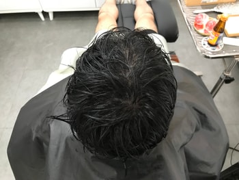 시술 후