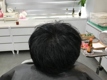 시술 후
