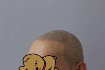 시술후