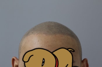 시술후