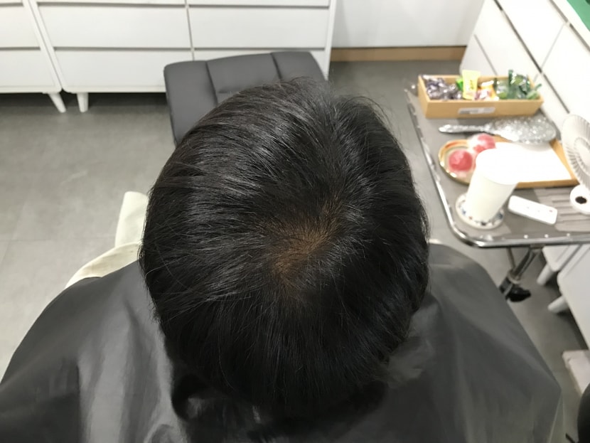 (시술전)